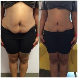 Woman Before and After Vevazz Laser Light Lipo Therapy S