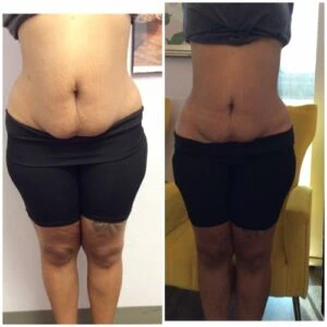 Woman Before and After Vevazz Laser Light Lipo Therapy U