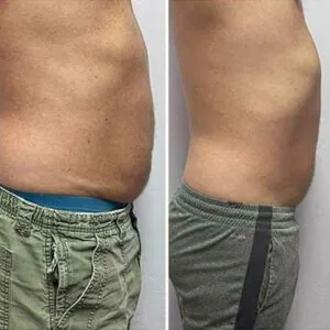 Full-body before and after shots of a woman post slimming treatment.
