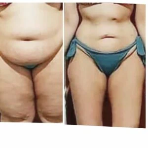 Woman standing before and after a non-surgical fat loss treatment.