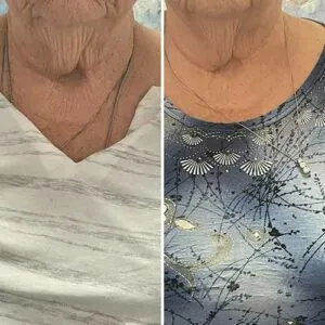 Comparison of a woman's face before and after a skin treatment.