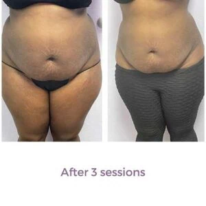 Before and after of a woman's abdominal area following body contouring.