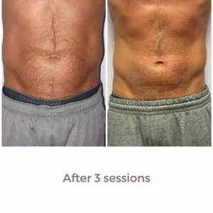 Woman's facial area before and after skin tightening procedure.