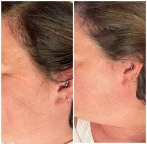 Side-by-side before and after results of a woman's facial profile improvement.