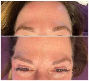 Close-up facial lines before and after wrinkle reduction.