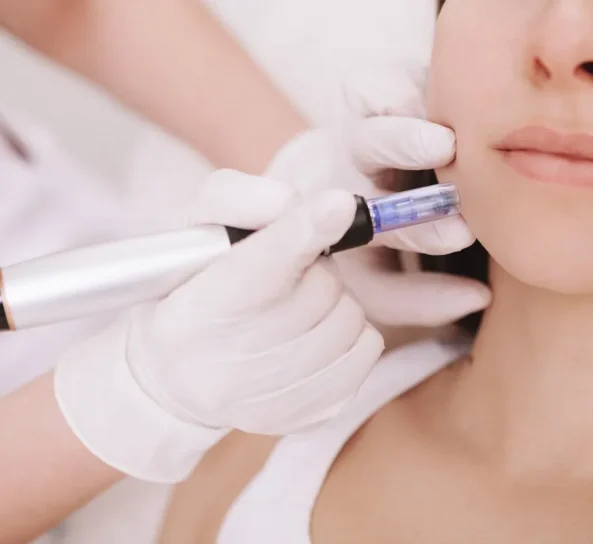 Microneedling device applied to face in Oklahoma City, OK